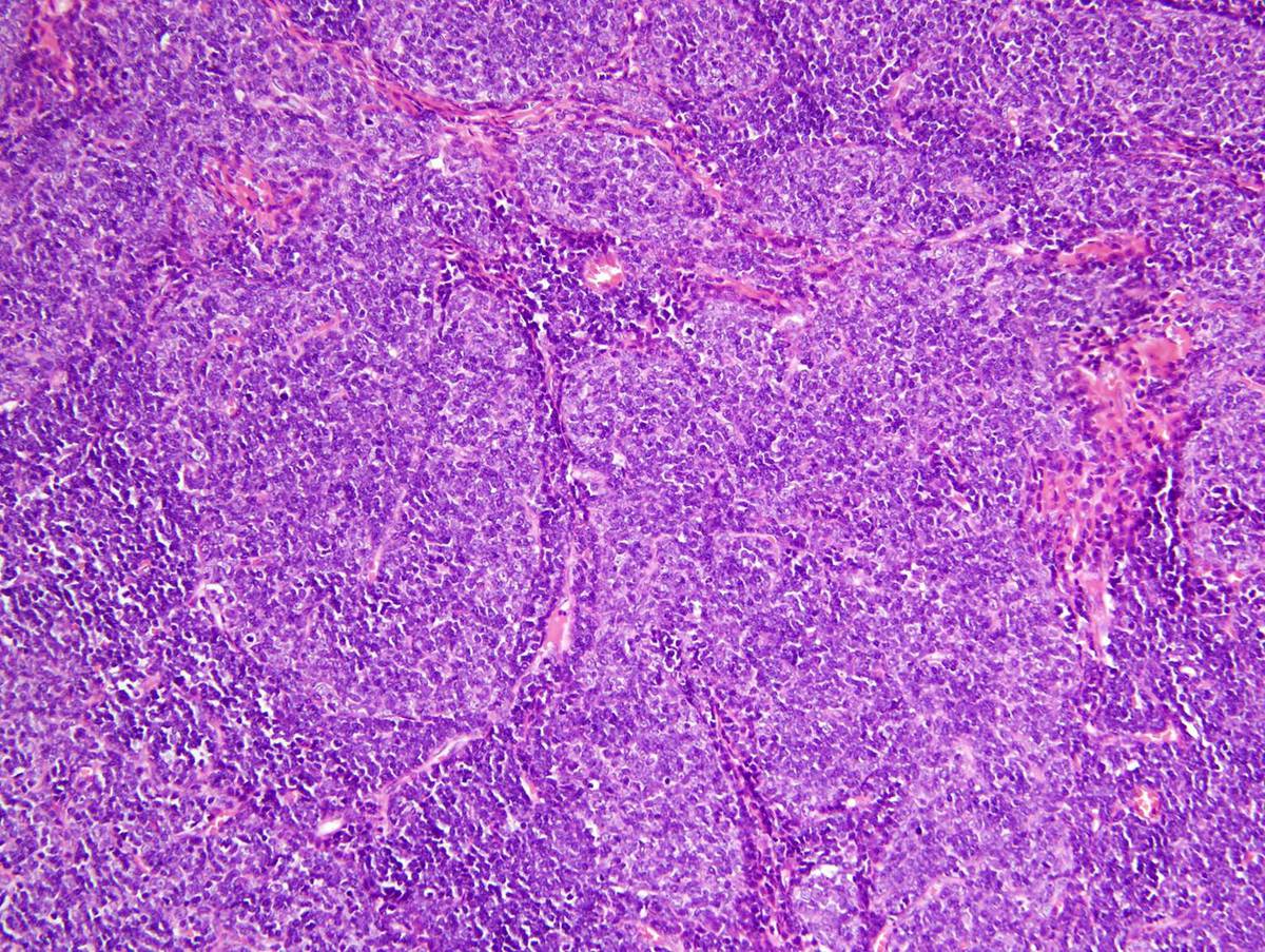 Mediastinal mass, epithelial cell proliferation